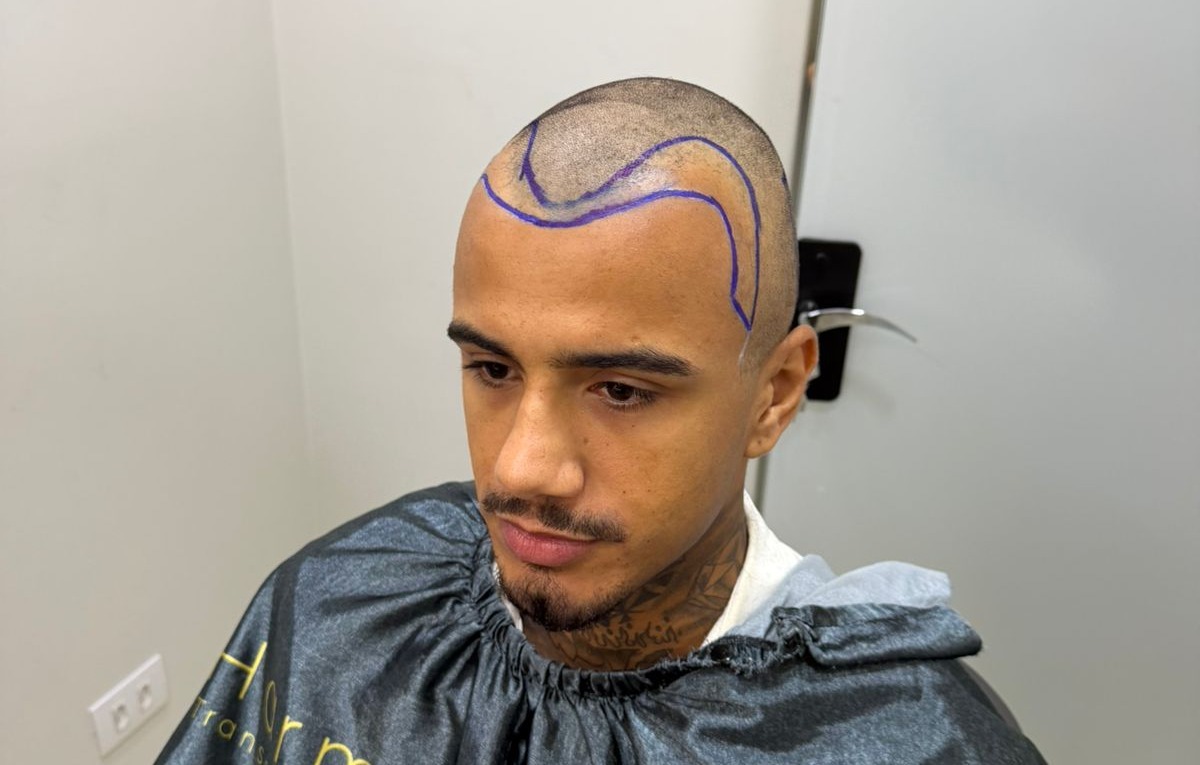 Imagem de Cantor Edi Mattos realiza transplante capilar e divulga fotos