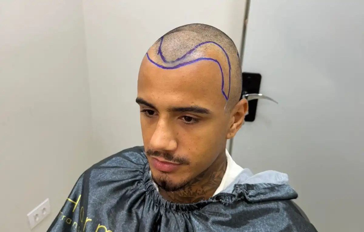 Imagem de Cantor Edi Mattos realiza transplante capilar e divulga fotos